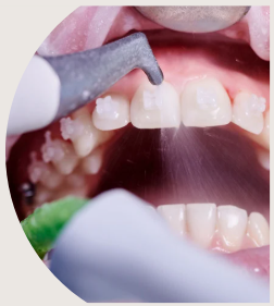 Illustration parti soins des traitements : bouche ouverte, vue sur bagues céramiques, petit jet d'eau actionné